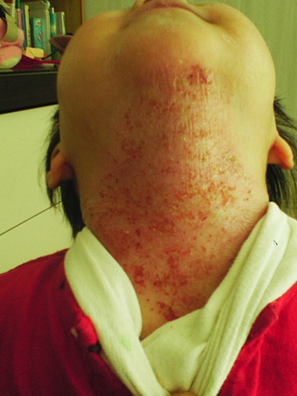 頸部異位性皮炎