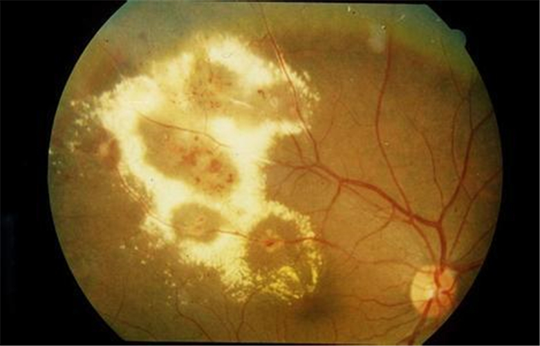 眼底疾病使視網膜脫落
