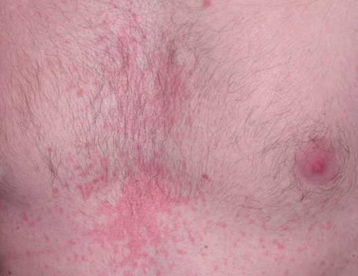 艾滋病紅疹症狀