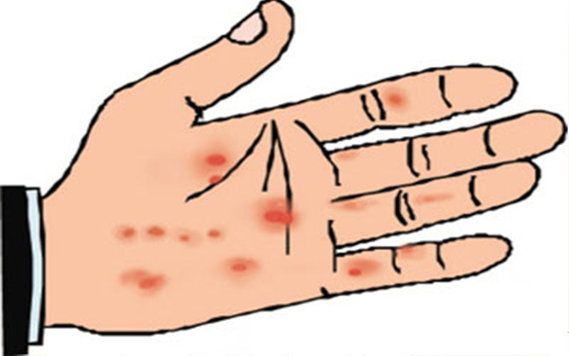 假性溼疣手部 