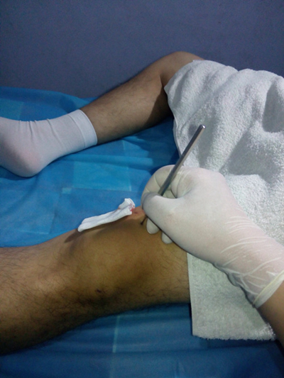 膝蓋半月板損傷症狀 (7) 