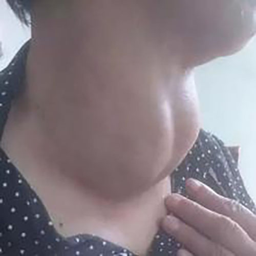 女子甲狀腺瘤腫大的症狀