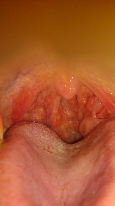 喉部淋巴濾泡增生 (5) 