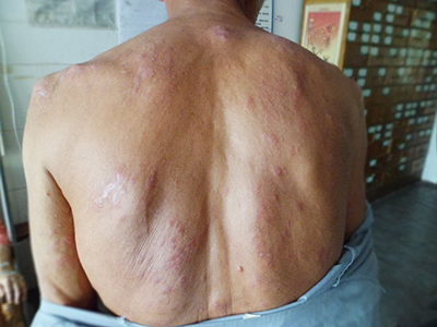 結節性癢疹 (41) 