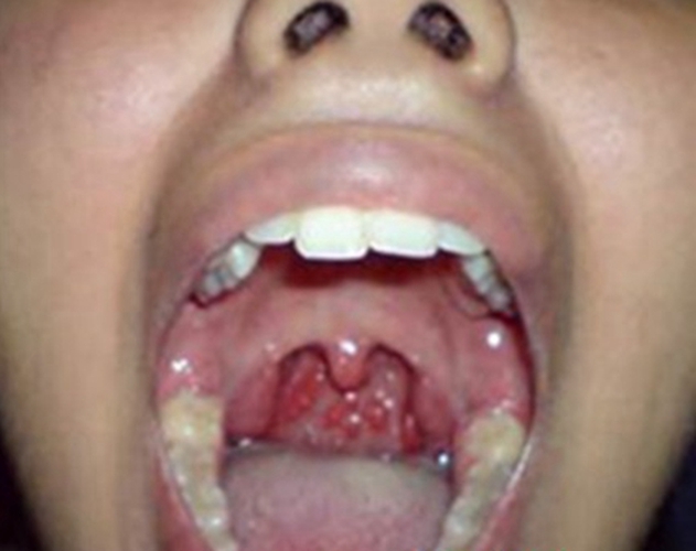 小孩急性咽炎症狀