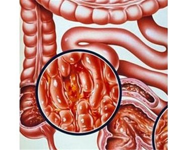 潰瘍性結腸炎症狀