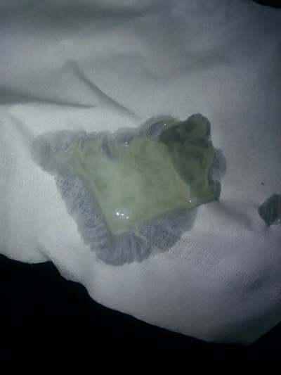 不正常精液液化