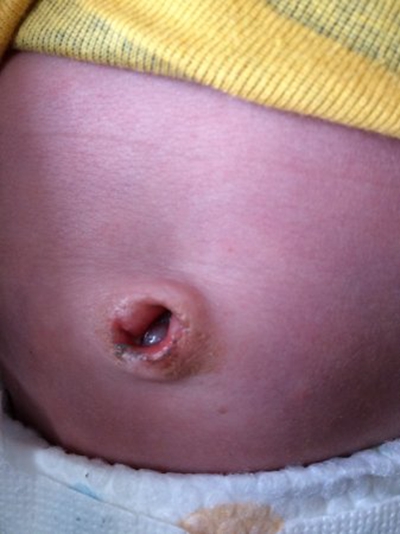嬰兒臍疝