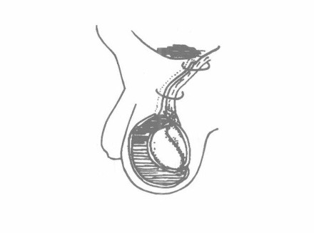 小兒鞘膜積液 (38) 