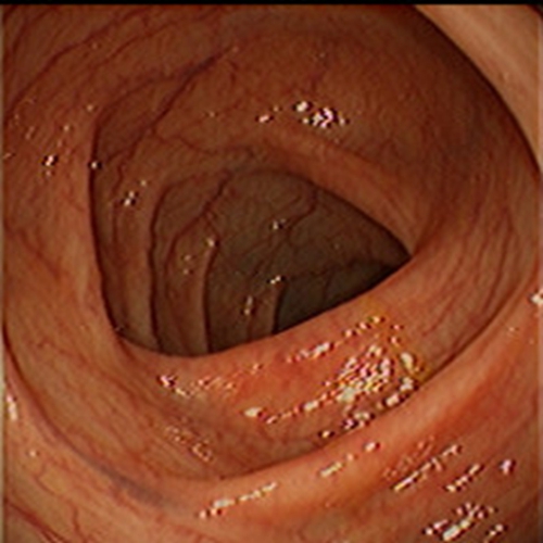 急性胃炎陽性的表現的
