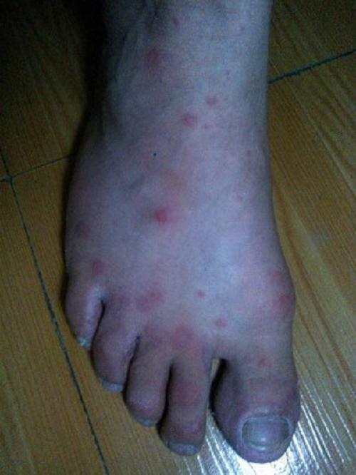 早期妊娠合併梅毒