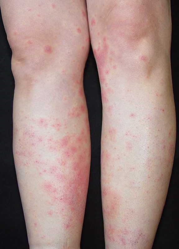 藥物性皮炎男性雙腿