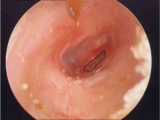 外傷性破裂鼓膜穿孔