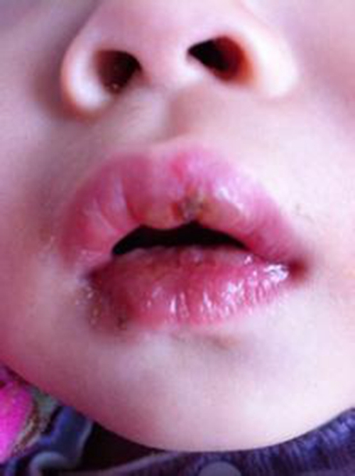 小孩子的淋巴結前期口腔發炎