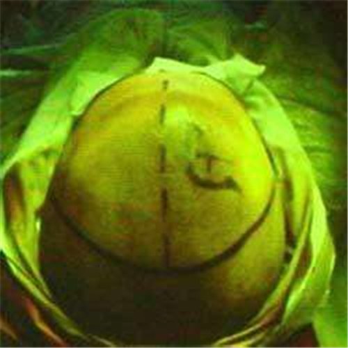 正常顱壓腦積水