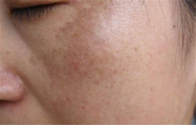 牛奶咖啡斑 (37) 