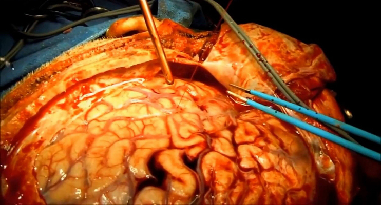 硬膜下血腫 (31) 