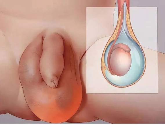 腹股溝斜疝 (60) 