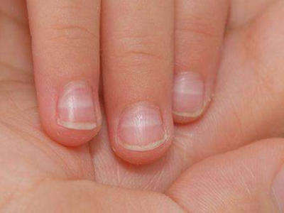 貧血指甲