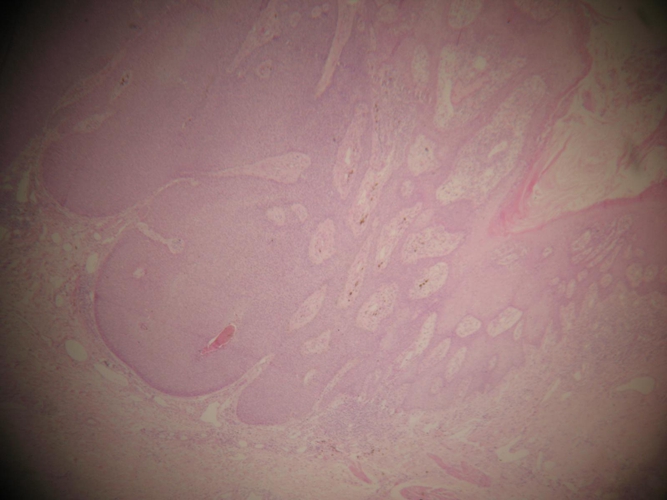 膝內側皮膚腫瘤