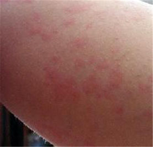 再生障礙性貧血手臂症狀