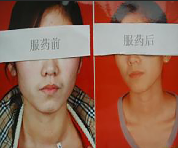 女性甲狀腺瘤服藥前後對比