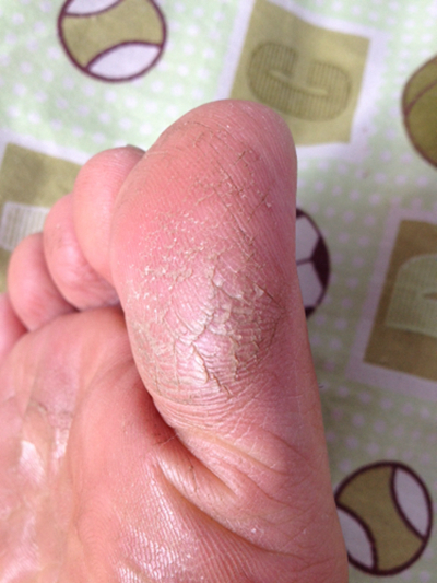 腳底乾裂 (38) 