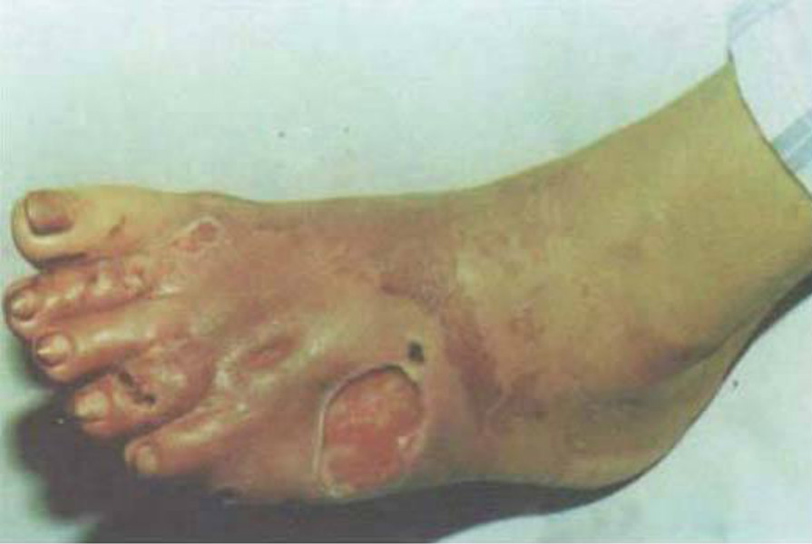 整個腳步皮膚念珠菌病