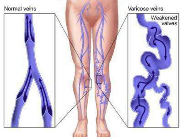 靜脈炎的原理漫畫 