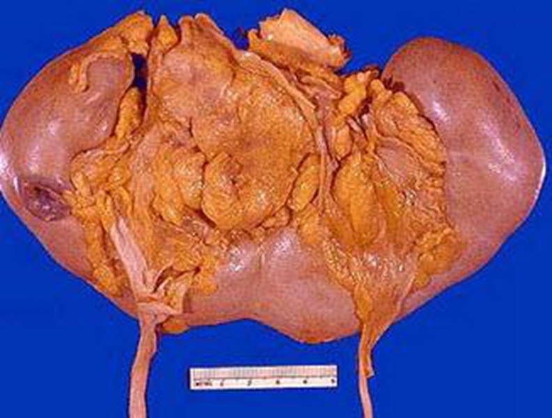 泌尿系統疾病切除器官 