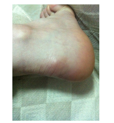 腳骨頭突出 (42) 