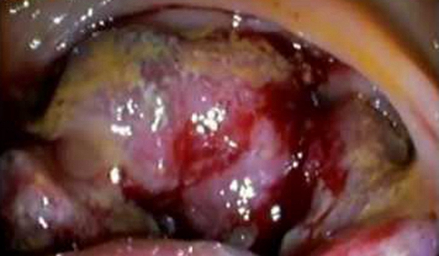 右半結腸癌不規則形未分化癌常見 臨床 特點