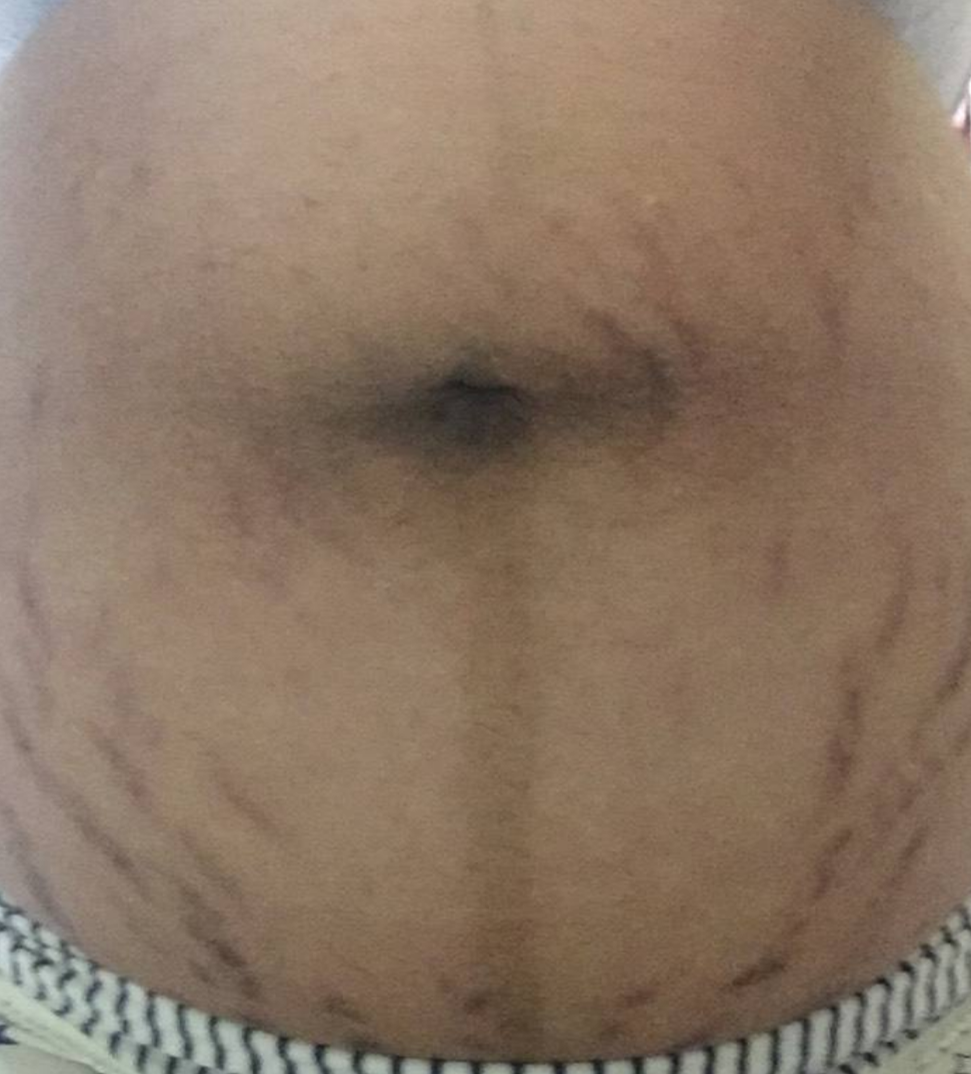 懷孕期妊辰紋的