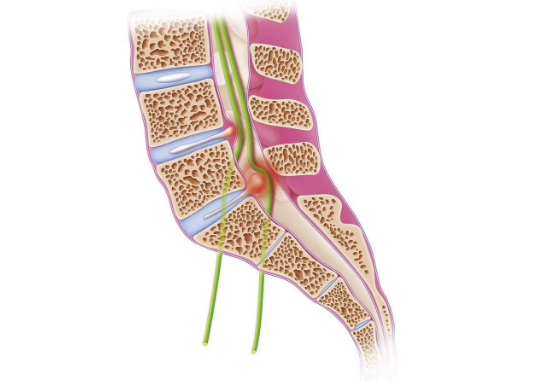 坐骨神經痛的症狀圖 (6) 