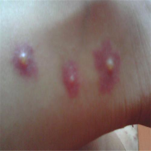 呼吸道感染引發皮膚皰疹