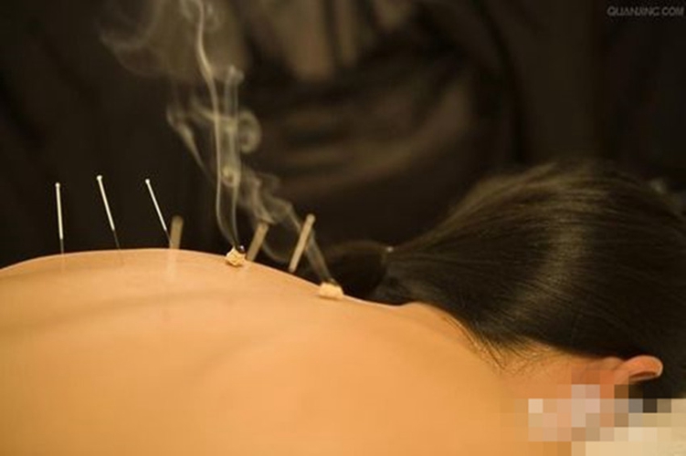 三叉神經痛針灸