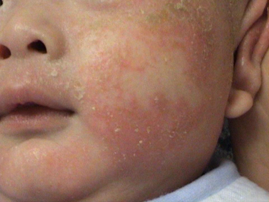 新生兒胎毒的症狀