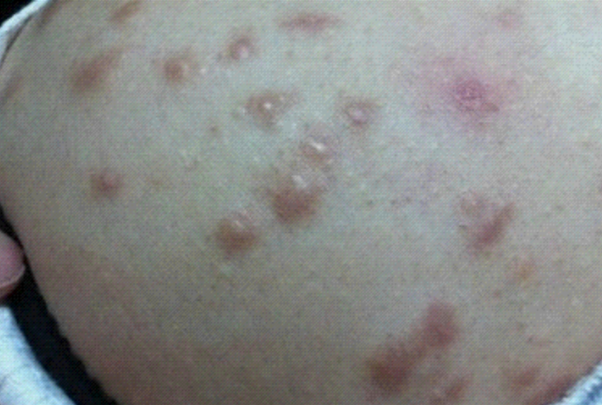 真菌性皮囊炎怎麼治 