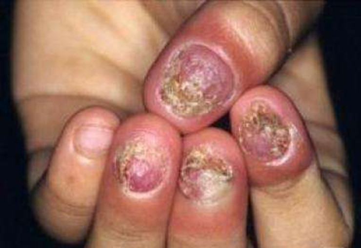 手指甲扁平苔蘚 