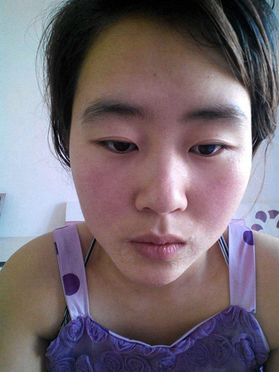 急性皮炎的症狀