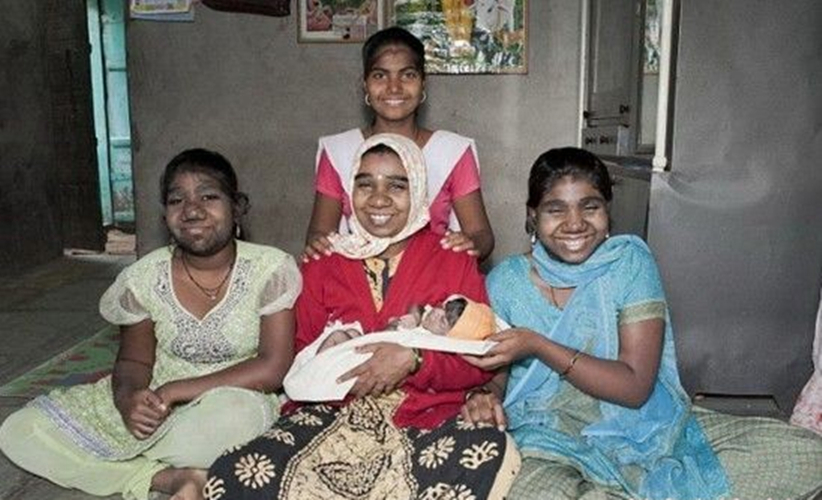 先天性全身多毛症