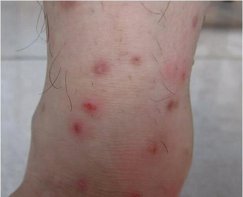 艾滋病紅疹症狀