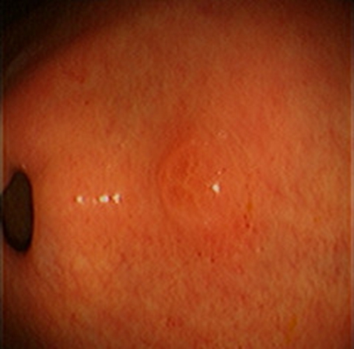 急性胃炎症狀表現