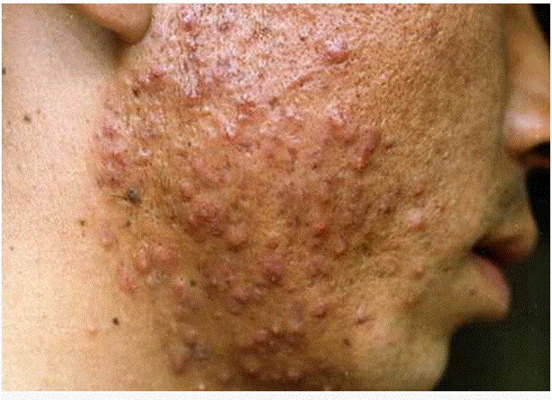 淋病的症狀 (49) 