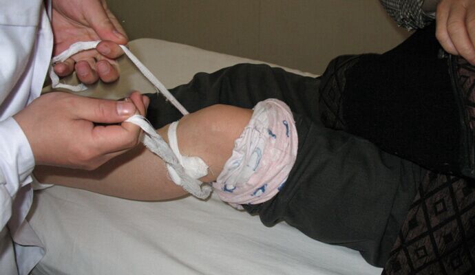 膝蓋骨質增生 (9) 