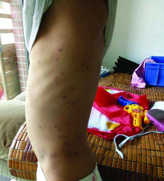 被跳蚤咬的症狀