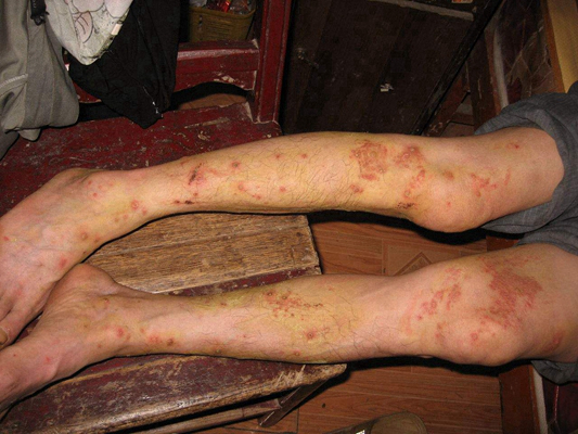 淋病的症狀 (51) 