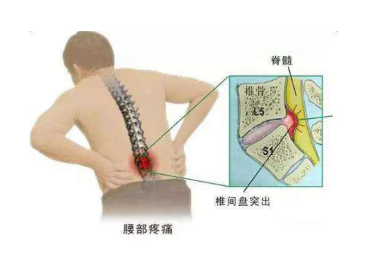 腰椎間盤突出症狀表現 (8) 