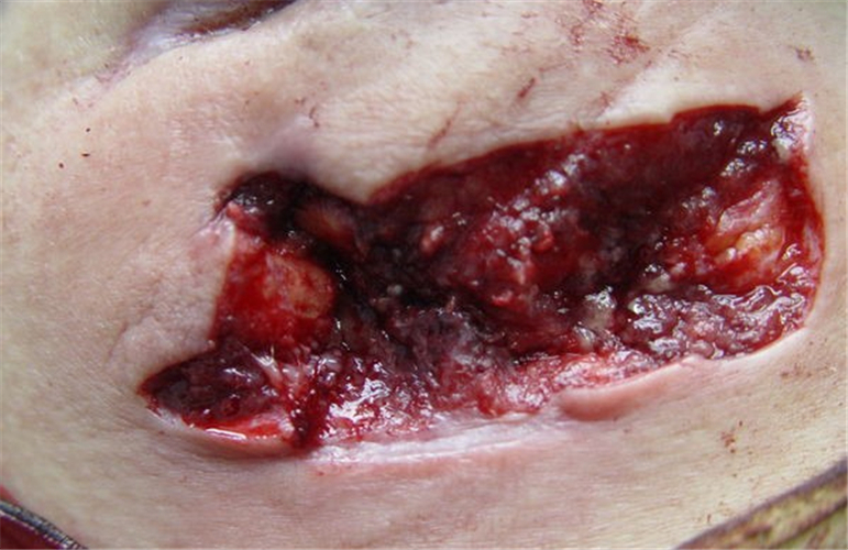 治療漿細胞性乳腺炎