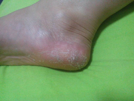 腳底乾裂 (35) 
